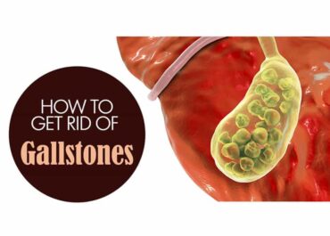 Gallstones Natural Treatment